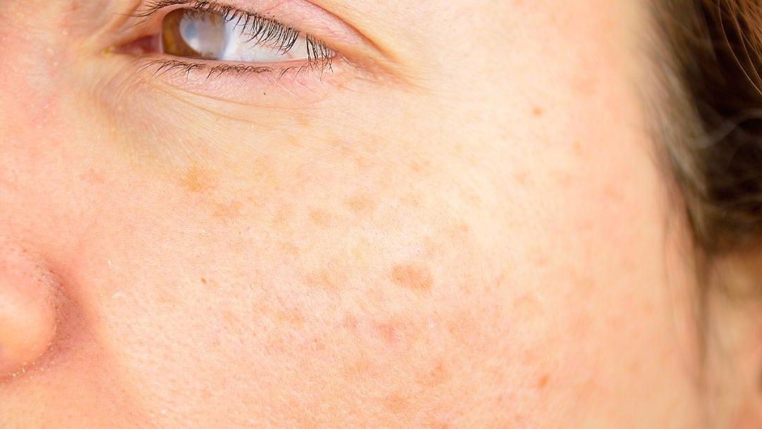 age spots
