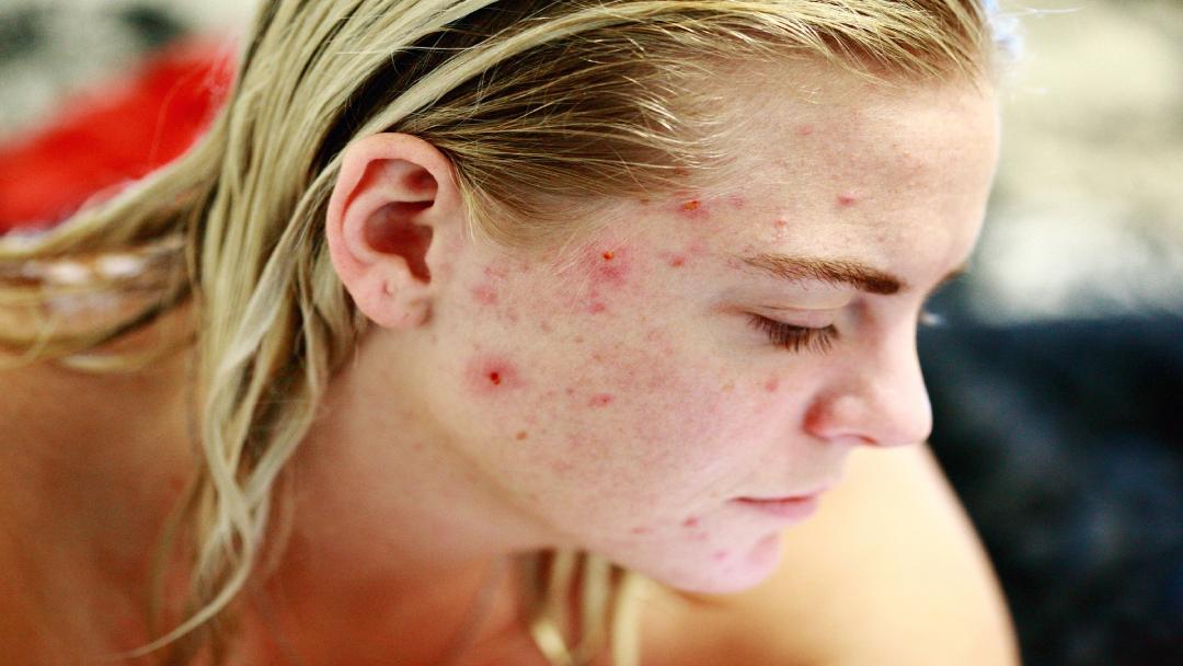 cystic acne