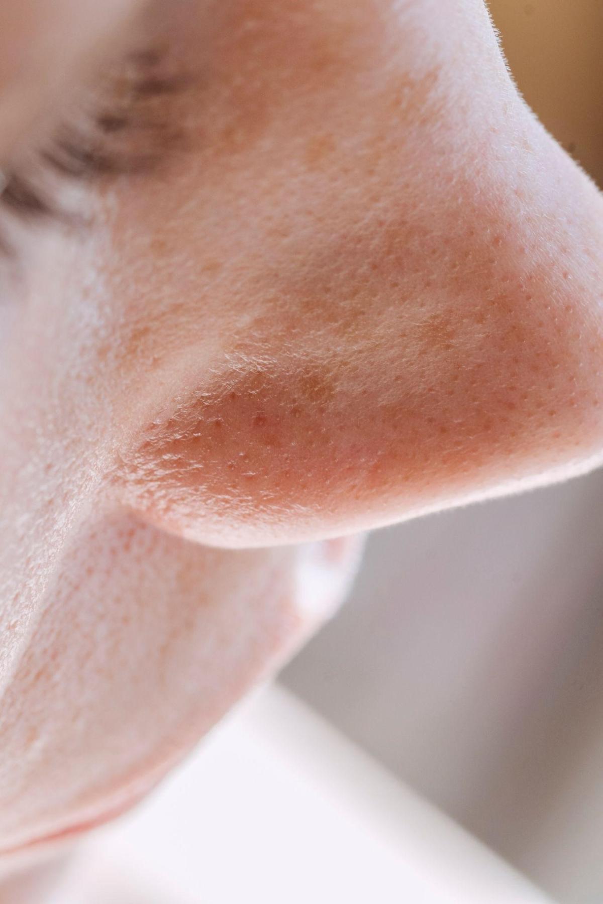 nose pores