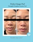 Pineapple Pumpkin Enzyme Peel 10%