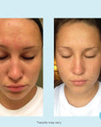 Glycolic 30% Gel Peel