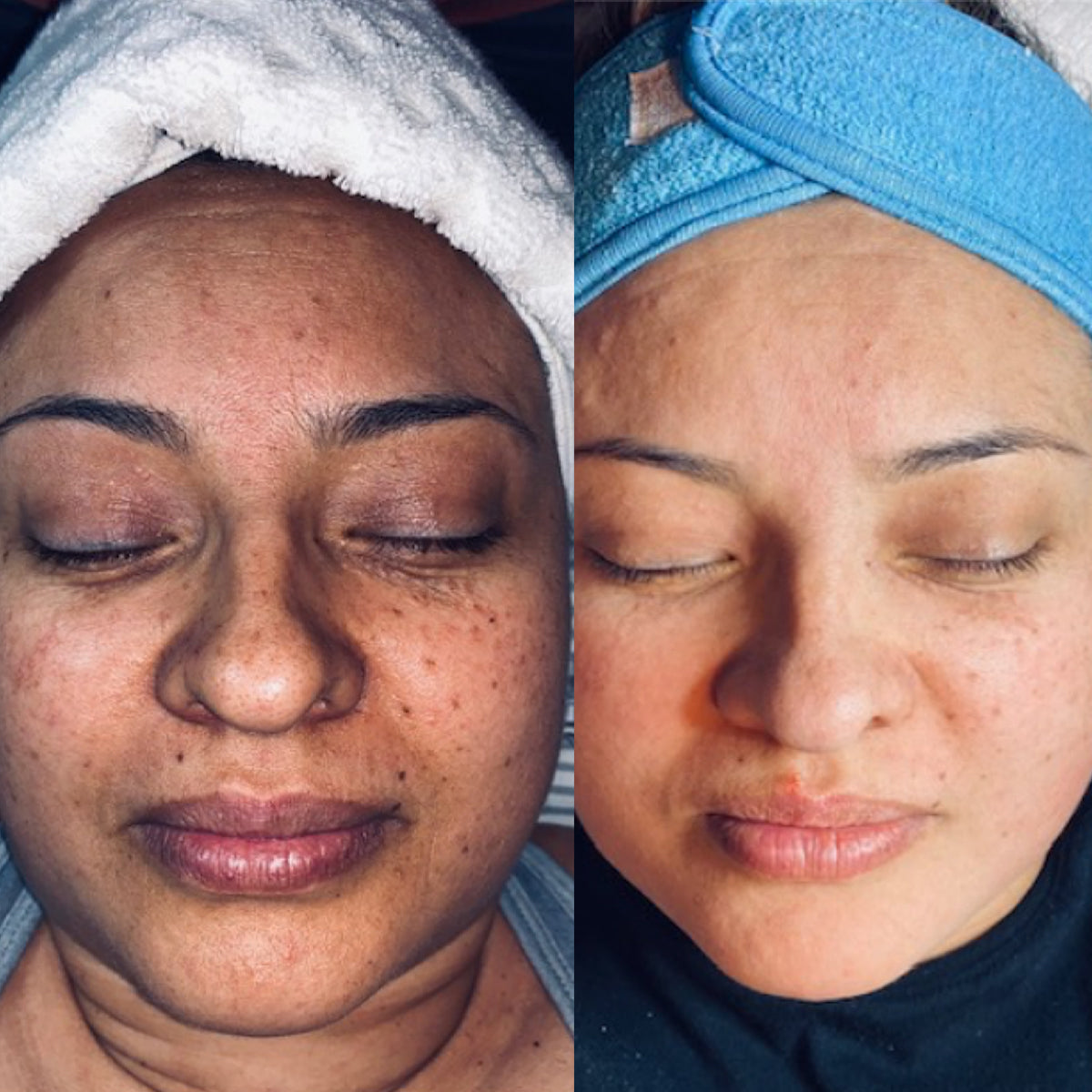 Glycolic 50% Gel Peel