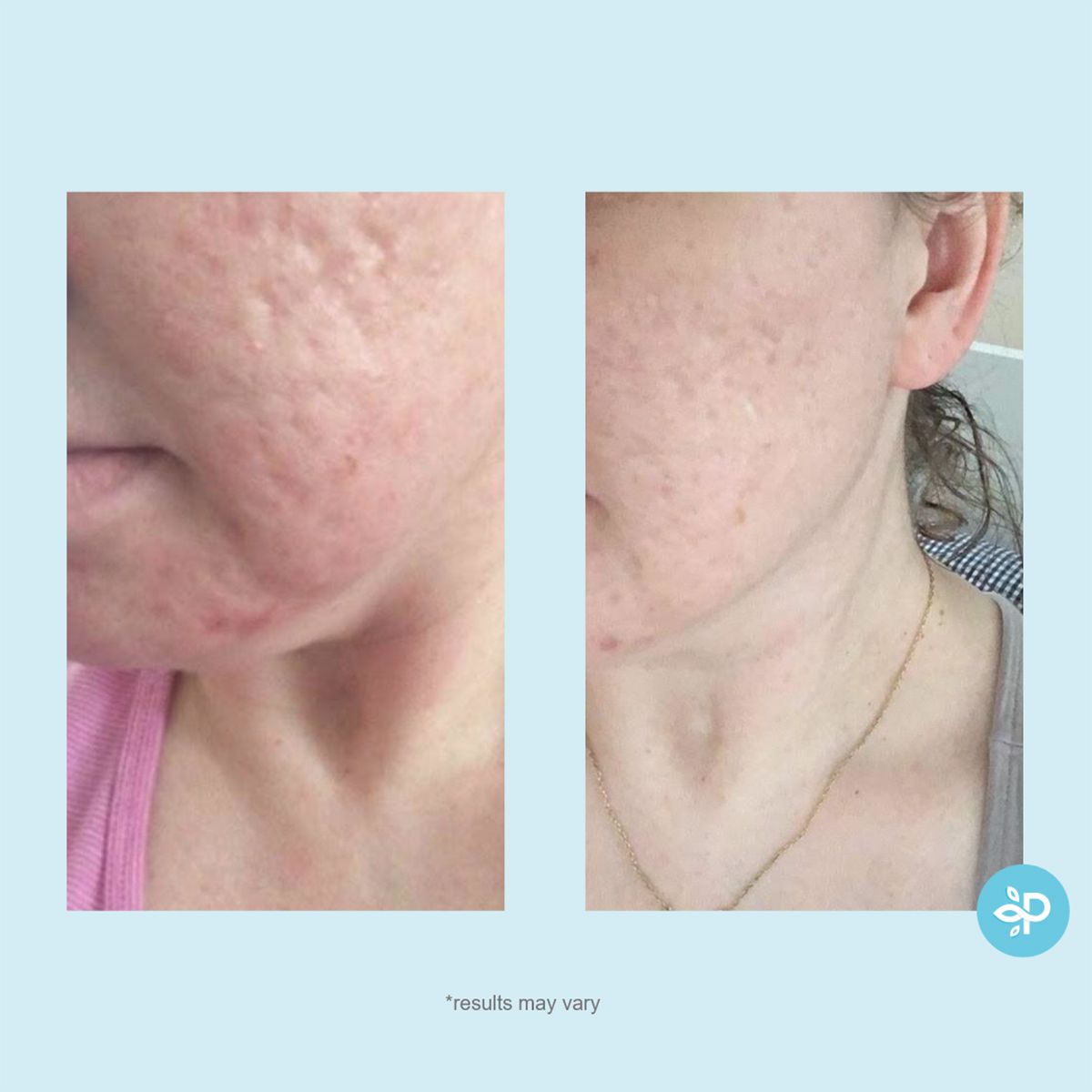 Glycolic 50% Gel Peel