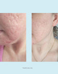 Glycolic 50% Gel Peel