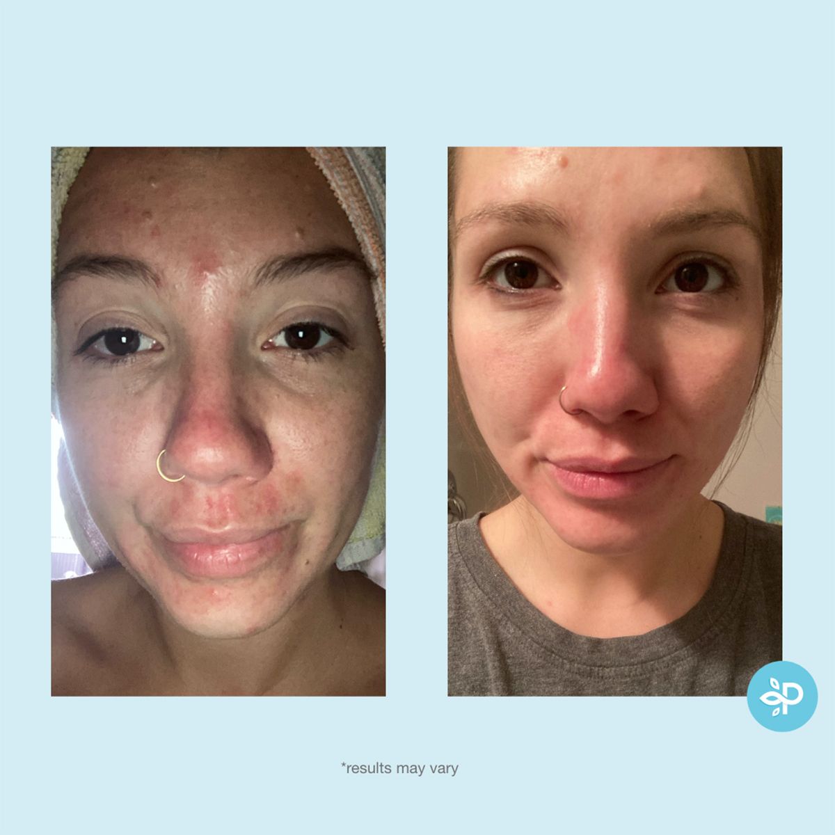 Glycolic 30% Gel Peel