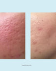 Lactic 50% Gel Peel