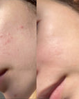 Lactic 10% Gel Peel