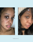 Salicylic 10% Gel Peel
