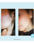 Salicylic 20% Gel Peel