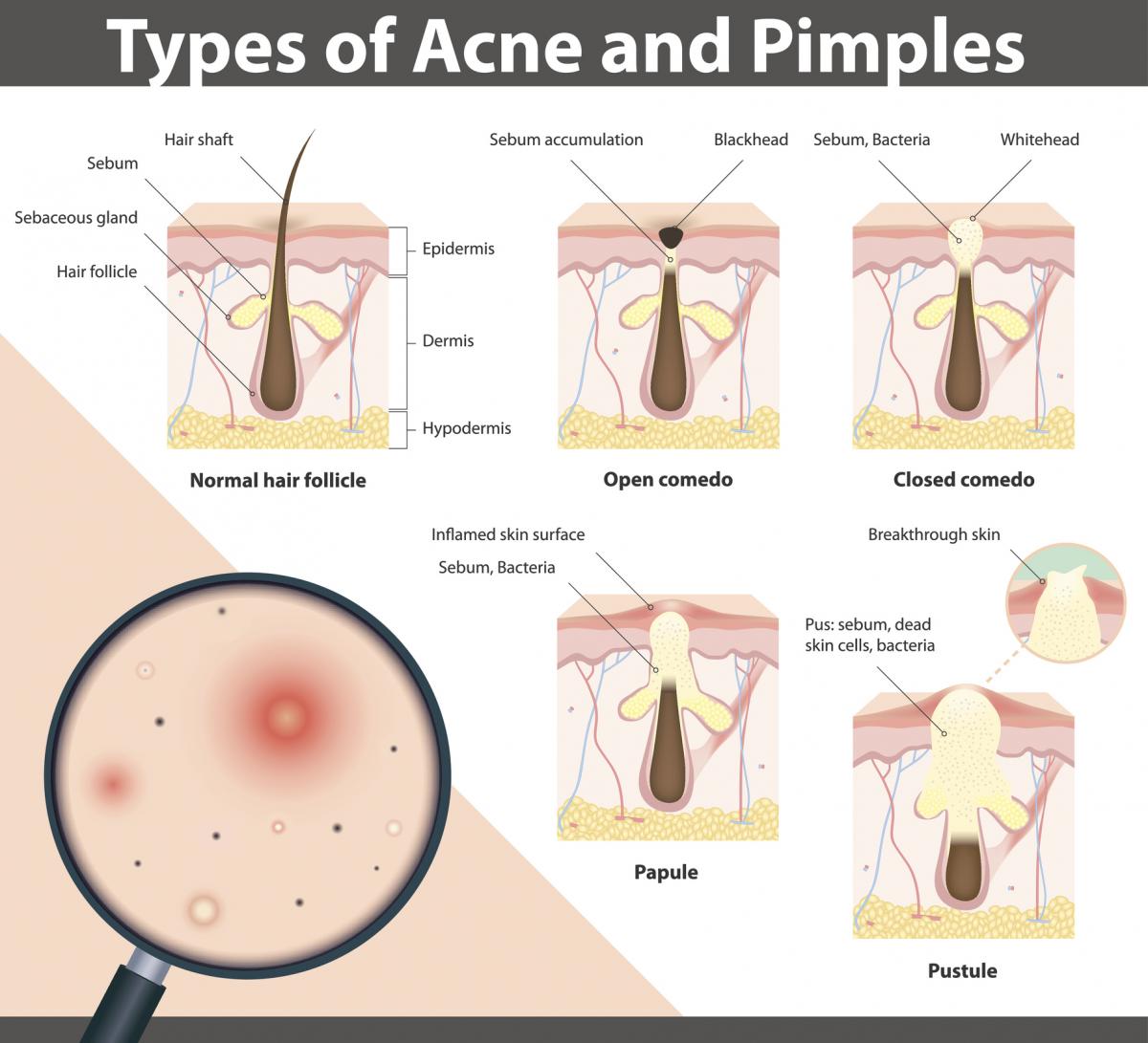 How do pimples form featured image