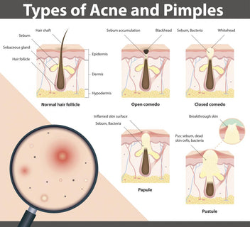 How Do Pimples Actually Form? The types and causes of Acne – Perfect Image