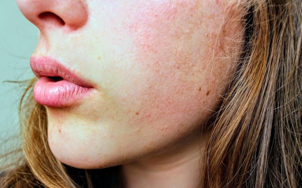 Rosacea: What It Is and How to Get Rid of It