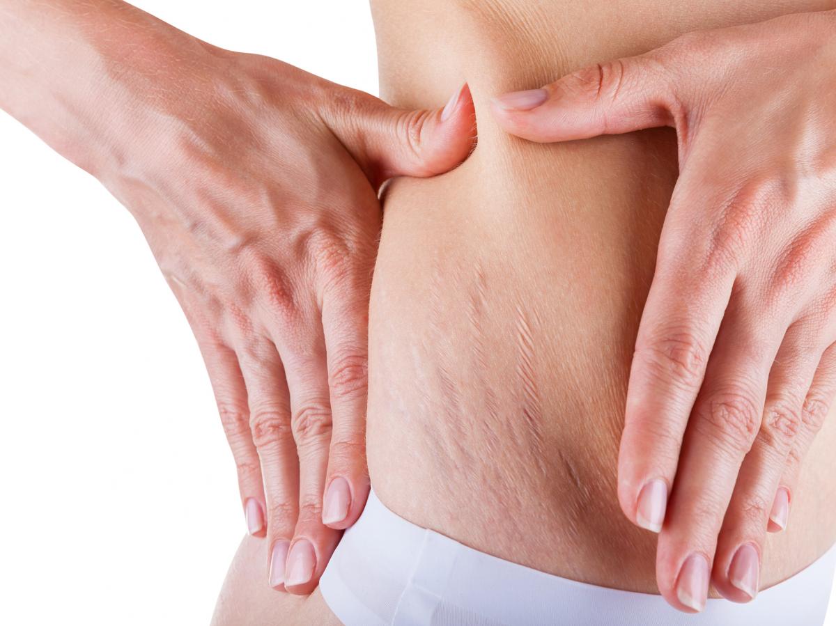 Home remedies for stretch marks featured image