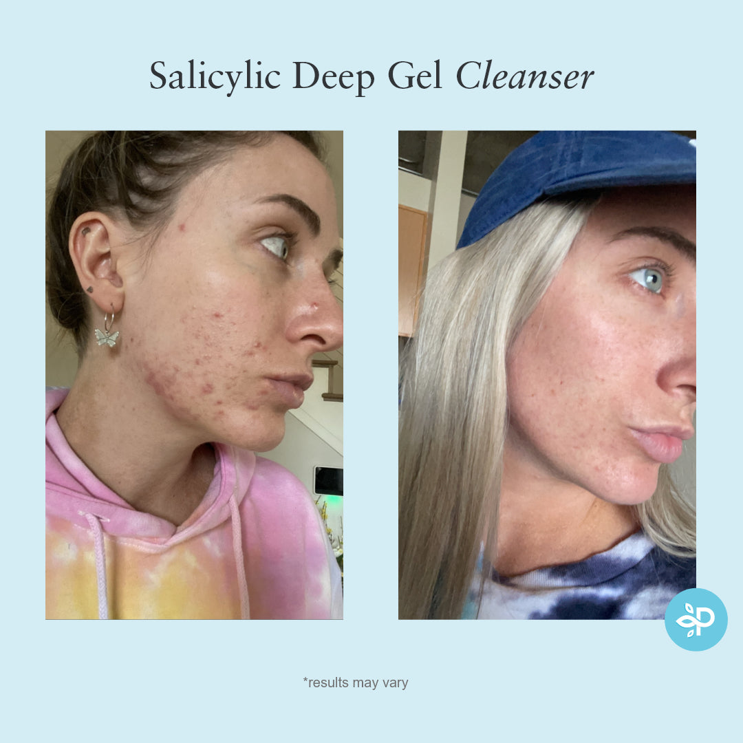Salicylic Deep Gel Cleanser – Perfect Image