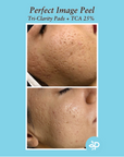 TCA 25% Skin Peel