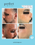 Lactic 70% Gel Peel