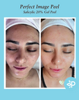 Salicylic 10% Gel Peel