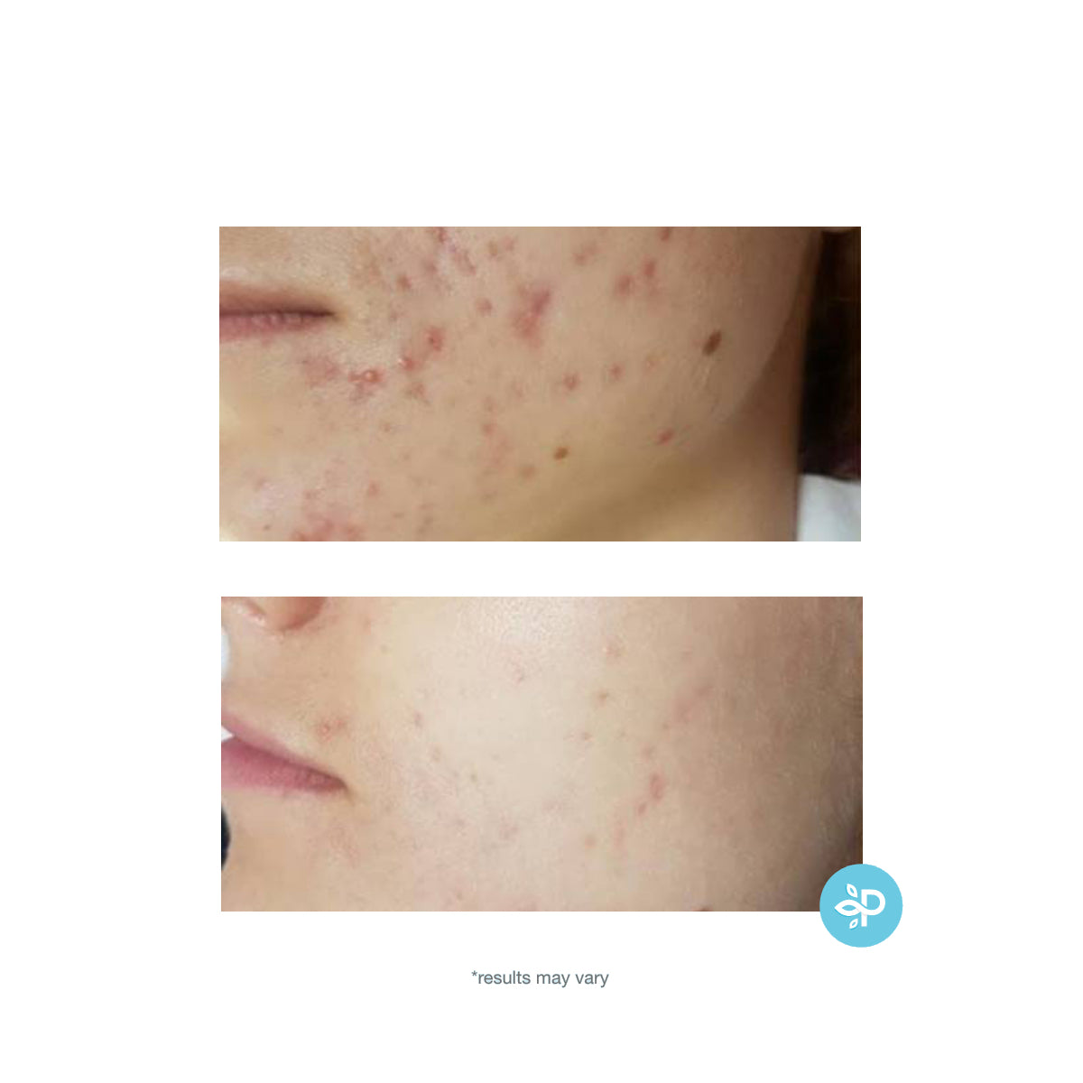 TCA 15% Skin Peel