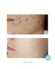 TCA 15% Skin Peel